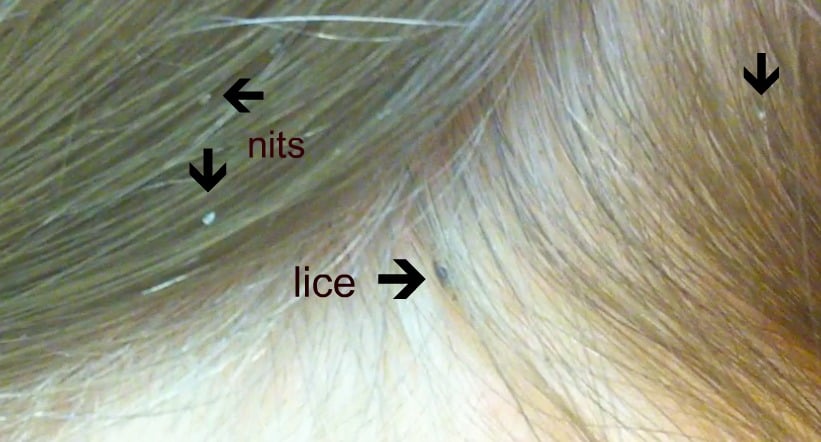 Head Lice Facts | Get Educated And Learn How To Prevent Lice